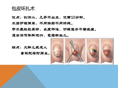 国产包茎在线,探索私密健康新领域